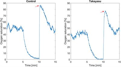 Affected Microcirculation and Vascular Hemodynamics in Takayasu Arteritis